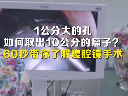 肚子里长了十几公分的肿瘤,微创腹腔镜手术是怎么把肿瘤取出来的呢?想不到塑料袋还有这种用途!#腹腔镜手术 #肿瘤切除 #肿瘤科普