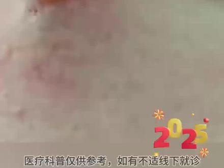 中医非遗——挑羊毛疔,羊毛疔是因为气滞血瘀产生的,王合民:挑羊毛就是要从根源解除瘀滞!#中医科普 #中医药文化 #非遗 #传承