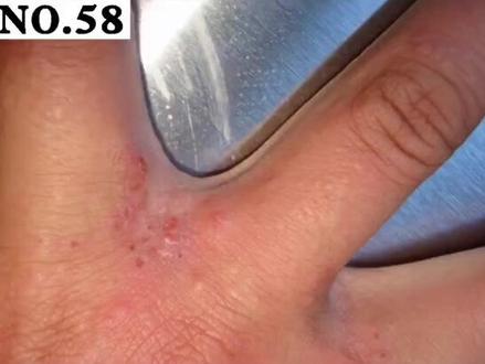 一到晚上就浑身痒的难受,身上还出现了很多小疹子,治疗#疥疮 这三点至关重要#医学科普