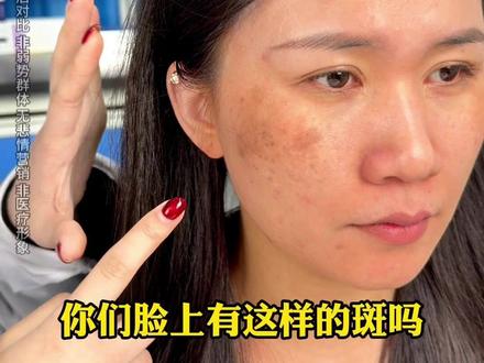 脸上长斑的原因是什么?#打斑瓷白瓶#美白淡斑#日常护肤