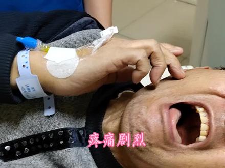 #三叉神经痛#疼痛科 洗脸刷牙轻微触碰诱发剧烈疼痛,局麻下三叉神经微球囊压迫术。