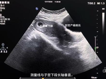 妊娠囊下缘到剖宫产瘢痕距离的测量
距离≥20mm,提示妊娠囊着床位置远离瘢痕,发生瘢痕妊娠或孕期子宫破裂的风险较低,可常规产检随访。
10mm≤距离<20mm,提示妊娠囊位置靠近瘢痕,需密切监测(每2-3周复查超声),观察囊体是否向瘢痕方向生长。
距离<10mm,或妊娠囊直接着床于瘢痕处(囊体部分/完全覆盖瘢痕),需高度警惕瘢痕妊娠,可能伴随大出血、子宫破裂风险,需进一步结合血β-HCG水平、肌层厚度等指标,由临床医生评估是否需终止妊娠。
#剖宫产瘢痕超声评估 #早孕期超声检查要点 #妊娠囊定位测量 #子宫下段超声解剖 #瘢痕妊娠超声筛查
