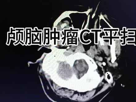 #医学影像 #急诊科医生
颅脑肿瘤CT平扫急诊读片