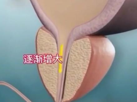 排N痛的3种情况,你是哪种 评论区告诉我。#排便 #尿道 #男性