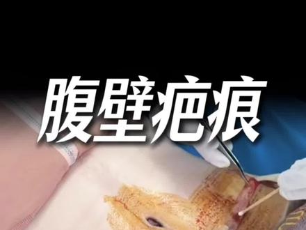 #西安腹壁医生欧阳武#腹壁疤痕 #吸脂联合腹壁成型 #西安腹壁