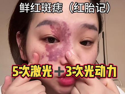 好好生活吧♥️一切都会慢慢变好的#鲜红斑痣 #经验分享