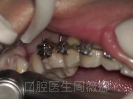 #智齿 拔除过程,看完感觉牙疼起来了#牙齿 #拔智齿