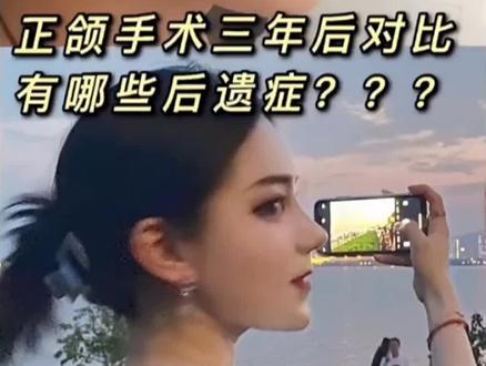 比较关心的后遗症问题#正颌 #我的变美进化史 #整容日记