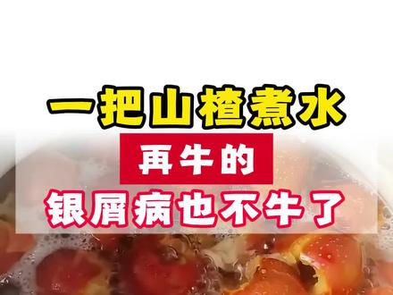一把山楂煮水,在牛的银屑病也不牛了#银屑病#皮肤#分享