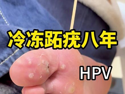 冷冻跖疣八年 为啥越治越多 #hpv #液氮冷冻 #跖疣 #抖出健康知识宝藏 #我的年度健康盘点