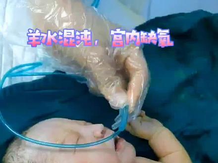 40周,女孩,羊水三度,身上黄染。宝宝缺氧太久,会造成非常严重的后果,宝妈们一定要多关注羊水的性状#新生儿 #健康