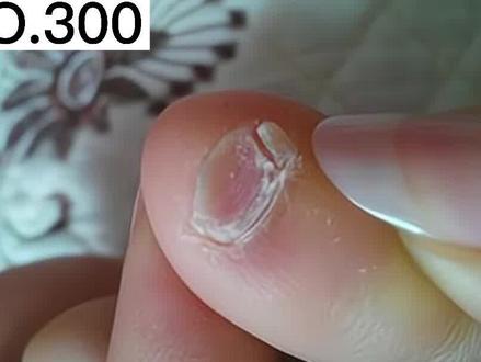 纯正汉人小脚趾甲都是两瓣的?听听皮肤科教授怎么说的,你们身边有人小脚趾也是这样的吗?评论里聊聊#指甲 #科普