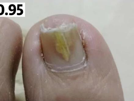 指甲变黄易碎,灰指甲如果不超过4个可以这样处理#科普 #灰指甲