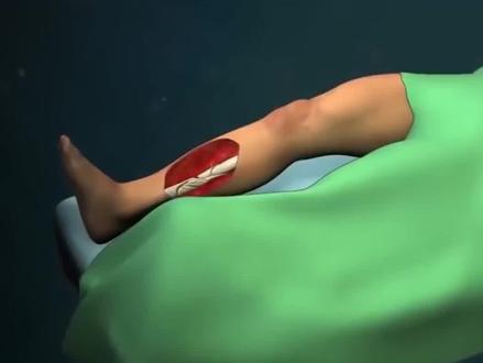 粉碎性骨折怎么康复#骨折 #骨科 #科普