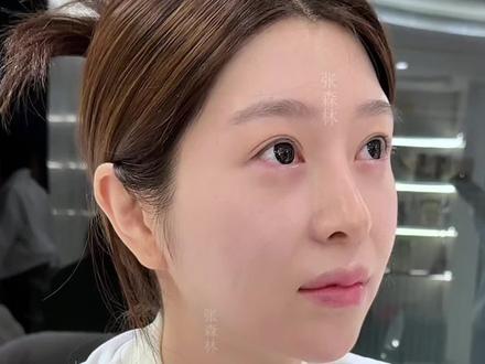 “无唇珠式”幼态唇 是你的菜吗❔ #人中#人中窝#口周幼态#变美#变美逆袭
出镜人已签署肖像权 医学科普仅供参考