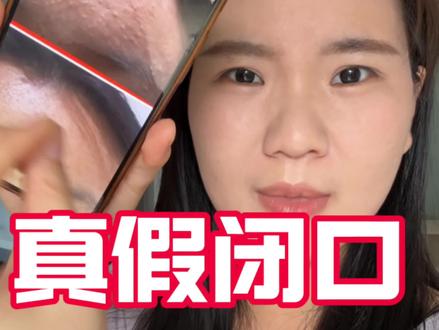 真假闭口教你分辨。自己脸上是什么东西都不知道?怎么会好呢?#闭口 #闭口粉刺 #痘痘 #疹子 #油痘肌