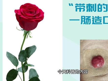 肠造口怎么护理?可以洗澡、锻炼吗? 投稿作者:吕俊玲 重庆市垫江县中医院胃肠疝甲状腺外科护士长