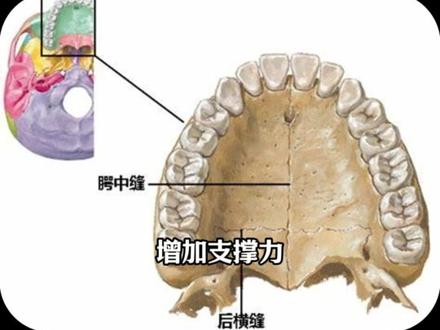 骨性扩弓真的能改变面型扁平吗? 首先,我们先来看看什么是骨性扩弓器和前芳牵引
【骨性扩弓器】
上颌骨扩弓器是一种用于矫正上颌骨狭窄的正畸辅助装置,实现上颌骨横向扩展
骨性扩弓器通过种植体或骨钉固定在腭骨两侧,提供稳定的支抗点,将力通过骨钉传递到上颌骨本身,避免力分散到牙齿导致倾斜。
通过骨钉直接作用于骨骼,实现骨性扩展,尤其适合青少年或成年早期腭中缝未完quan闭合,扩展效果更稳定、范围更大。
【前芳牵引】
前牵也是正颌领域中用于上颌后缩的重要技术,通过施加向前的牵引力,刺激上颌骨生长,改善面型及咬合关系。其核心原理也是基于骨骼生长的可塑性和牵引力对骨缝的刺激作用
这个孩子主要是上颌发育不足、面中塌陷,牙齿不齐和下巴颏突出,现在还处于成长高峰期,所以我们利用的是骨性扩弓器,把腭中缝撑开,加上前牵,给上颌骨一个持续的向前的牵引力,这样就可以让面中部往前撑出,改善鼻基底塌陷等问题,面型可以得到改善。
#骨性扩弓 #鼻基底凹陷#骨性扩弓器 #前方牵引矫治器 #东莞牙齿矫正