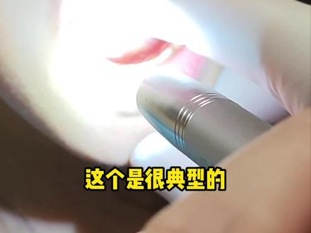 舌下腺囊肿没有特别的危害,如果对生活没有影响可以不做手术。#唾液腺囊肿 #舌头下边长肉疙瘩 #口腔健康