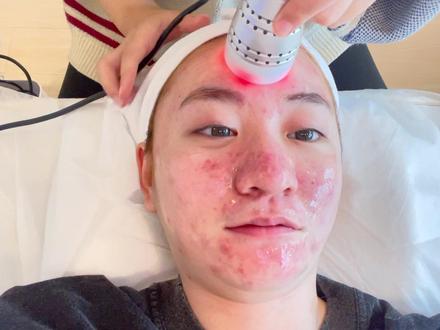 针清到底要花多少钱?最推荐的方式是什么?10年针清经验真实分享#如何祛痘 #油痘肌 #大数据推荐给有需要的人 #祛痘 #针清 @创作灵感小助手