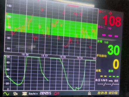 第一胎胎儿宫内窘迫,频繁胎心减速,充分评估后选择自然分娩,我们的宝妈真是很努力,全力配合,最终顺利分娩,👩🏻👦🏻平安!#皖北总院产科#产房#顺产#每一位妈妈都是伟大的 #感动瞬间