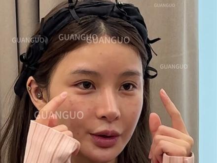 花了5个vv做的双眼皮修复,狐系魅惑感get~ 出镜人已满二十五周岁并已签署出镜协议
仅为个案,不宣导任何医疗项目
如有不适请及时就医#双眼皮修复管果#眼修复#上海双眼皮#管果双眼皮#眼综合