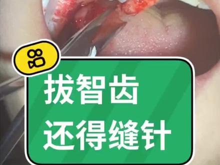 还是智齿,埋伏智齿拔除#爱牙护牙 #口腔科普 #唯美度口腔