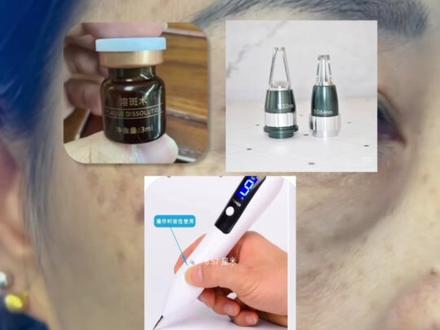 反黑多久能够好? 简单的科普知识#美容 #科普 #祛斑 #斑斑点点 #真皮斑的消除方法