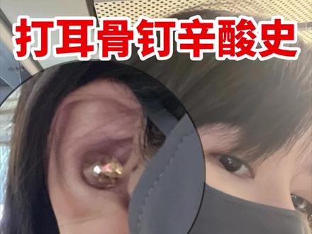 耳蜗耳骨钉的血泪代价!兄弟们三思!
