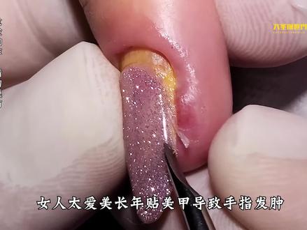 女人太爱美长年贴美甲,导致手指肿胀发烂 #变美 #指甲 #美甲