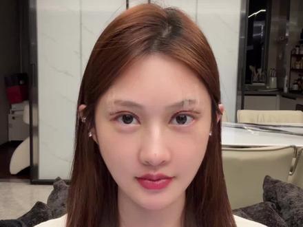 每一个项目最煎熬的就是恢复期谁懂啊#双眼皮