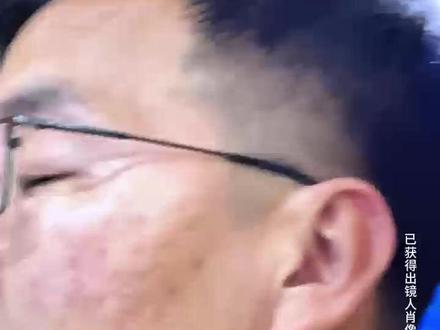 adm填充痘坑俩月反馈~ 所有内容均来自真实反馈,已获得顾客肖像使用权,搬运抄袭必究!!! #adm填充痘坑 #皮下分离 #痘坑怎么办 #真实反馈 #内容仅供参考