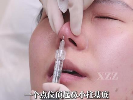 只需一个点位顶起鼻小柱,改善扁塌鼻 #塌鼻子 #鼻小柱 #蒜头鼻 #do鼻 #注射