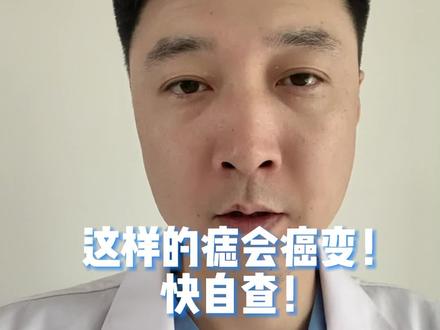 这样的痣会癌变!快自查!#黑色素瘤#黑色素瘤和黑痣的区别在哪 #黑痣 #黑痣要不要祛除 #医学科普