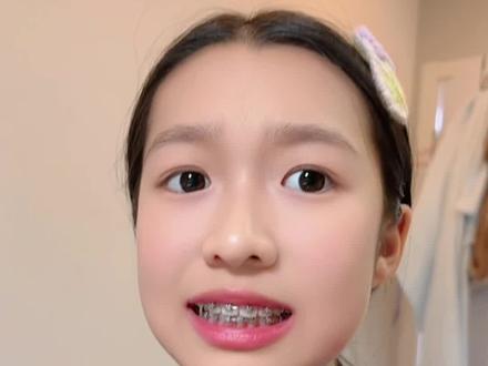 挂皮筋了#牙套#牙套日记#整牙#钢牙