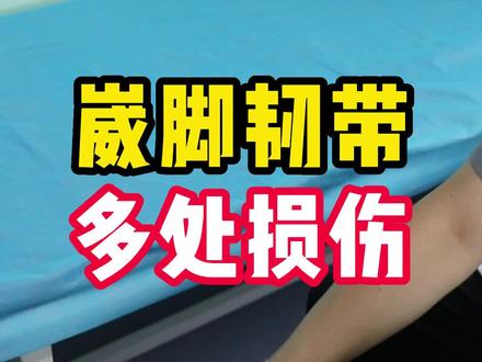 崴脚导致韧带多处损伤#崴脚 #骨科医生 #夏季健康全攻略