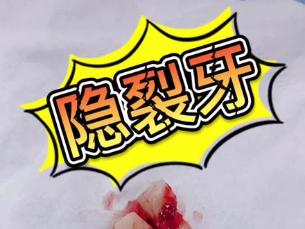 #隐裂牙#拔牙 #口腔健康 隐裂牙为一种细微不易发现的牙齿裂缝,多见于恒磨牙,其次为前磨牙。它可引起牙体、牙髓、尖周和牙周一系列病变、