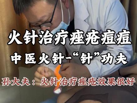 中医火针治疗痤疮,效果佳 #中医针灸#火针#洛阳孙大夫#中医埋线#痤疮痘痘