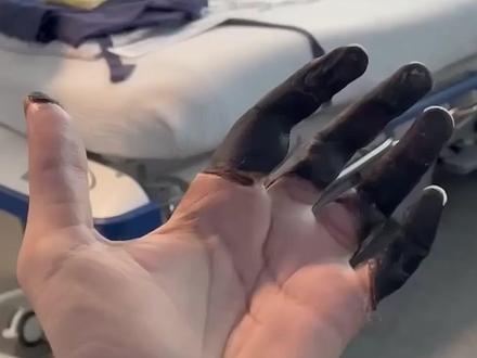 手指被冻伤以后,为何会黑的像炭一样?又该如何应对? #手指 #冻伤 #涨知识 #截肢 #内容启发搜索