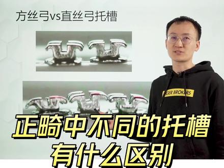 正畸中不同的托槽有什么区别
托槽是我们在正畸中最常用的固定矫治器。托槽就是粘在牙齿上面,这个亮亮的金属片就叫做托槽。钢丝穿在托槽上面,依靠结扎圈或者结扎把钢丝结扎到托槽上面,最终来排齐牙齿。
我们经常听到的方丝弓托槽、直丝弓托槽、自锁托槽、舌侧矫治、全隐形矫治器、陶瓷托槽,它们都有什么区别呢?
托槽虽然有各种各样的特色,但实际上决定你治疗效果好坏的并不取决于托槽。而取决于你的医生,如果选择好的医生,那么无论你使用任何的托槽,都可以达到很好的效果。
#正畸 #整牙 #牙套 #托槽 #固定矫治 #隐形矫治