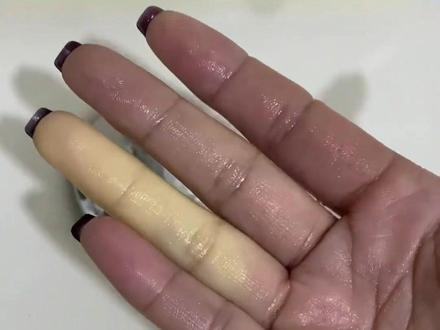 女子手指受冻后异常惨白。警惕!这不是冻伤 医生:是雷诺现象#雷诺现象 #冻伤 #手指 #健康