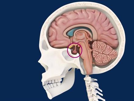 #颅咽管瘤 #神经外科郭毅 #健康科普 3d动画颅咽管瘤