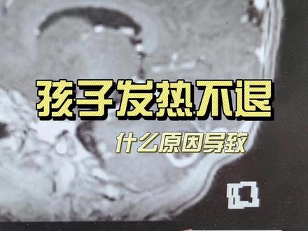 孩子一直发热不退什么原因引起?#脑膜炎 #儿童脑科小米大夫