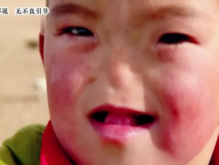 【第二集】无鼻男孩:我想闻到花香。@鸿影纪事 #纪录片 #异国他乡的生活 #关爱儿童健康 #关注罕见病