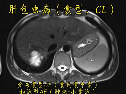 肝囊型包虫病
脏囊型包虫病(CE)的分型和MRI诊断要点如下:
一、肝脏囊型包虫病的分型
根据影像学表现,肝脏囊型包虫病可分为以下几种类型:
1. 囊型病灶(CL型):囊壁不清晰,内容物回声均匀,通常呈圆形或椭圆形。
2. 单囊型(Ⅰ型):棘球蚴囊内充满水样囊液,表现为圆形或卵圆形的液性暗区,囊壁与肝组织密度差异明显,可出现“双壁征”。
3. 多子囊型(Ⅱ型):母囊内出现多个较小的球形暗影及光环,形成“囊中囊”特征性影像,CT或MRI上可表现为花瓣形分隔的“车轮征”或“蜂房征”。
4. 内囊破裂型(Ⅲ型):内囊破裂后,囊液进入内外囊壁间,出现“套囊征”或“天幕征”,囊壁可能塌陷、收缩,形成“飘带征”。
5. 实变型(Ⅳ型):囊液吸收,囊壁折叠收缩,继而坏死溶解呈干酪样变,B超或MRI上可显示密度强弱相间的“脑回征”。
6. 钙化型(Ⅴ型):囊壁发生钙化,B超或CT上显示为不均匀的高密度影,伴宽大声影。
二、MRI诊断要点
1. 基本表现:
• 肝脏内出现圆形或类圆形的囊性病灶,T1WI上呈低信号,T2WI上呈高信号。
• 囊壁可显示为双层结构(“双壁征”),内囊壁光滑,外囊壁较厚。
2. 特征性表现:
• 囊中囊征:母囊内出现多个小囊,T2WI上子囊信号高于母囊。
• 飘带征:内囊破裂后,囊壁塌陷漂浮于囊液中。
• 脑回征:囊液吸收后,囊壁折叠收缩,形成类似脑回的影像。
• 晕带征:病灶周边的新生小囊侵蚀肝组织,形成低信号的“晕带”。
3. 钙化表现:
• 囊壁或囊内钙化在T1WI和T2WI上均呈低信号。
4. 扩散加权成像(DWI):
• 肝囊型包虫病的ADC值显著低于单纯性肝囊肿。当b值为1000 s/mm²时,病灶ADC值≤2.650为诊断肝囊型包虫病的最佳截断点,其敏感度为0.824,特异性为0.762。
MRI检查具有无辐射、软组织分辨率高的优势,能够清晰显示肝脏囊型包虫病的典型特征,是重要的诊断工具。
#医学影像 #磁共振 #肝包虫病 #囊型包虫病