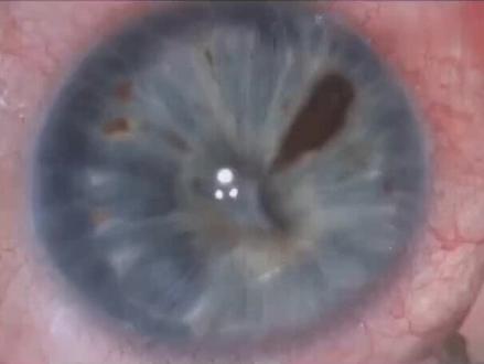 #上热门 你见过瞳孔膜切吗#微观世界 #科普