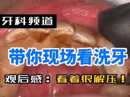 带你现场看看洗牙的过程,看完后说说你的欢后感!#口腔科邓教授 #口腔科普 #口腔健康 #洗牙