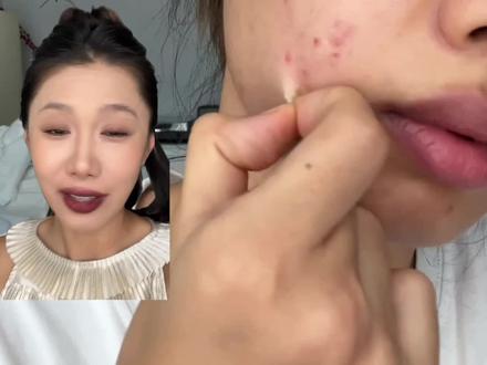 痘痘贴真不是智商税!实测有用的都在这了别踩雷 #痘痘贴 #省钱测评