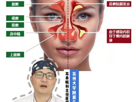 耳鼻喉科主任分享|儿童鼻窦炎,4步治疗流程! #医疗健康创作训练营#慢性鼻窦炎#鼻炎#满级小孩成长守护手册#抖出健康知识宝藏