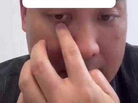 今天来的大姐眼下长个泪痣,两个月越长越大,不先看病先算命,这让我该怎么劝我的好大姐#什么样的痣需要警惕 #祛痣 #点痣 #医美人